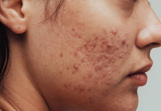 Pimples and Acne - Causes and Treatments
