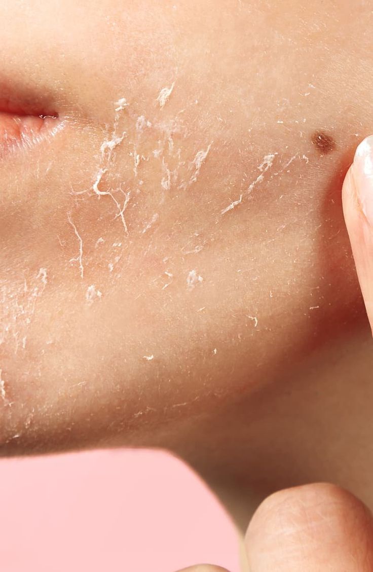 Extremely Dry Skin: Causes, Symptoms, and Treatment
